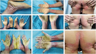 Case Report: Challenges in the Diagnosis of a Case of Mal de Meleda and a Therapeutic Attempt of Ixekizumab and Adalimumab